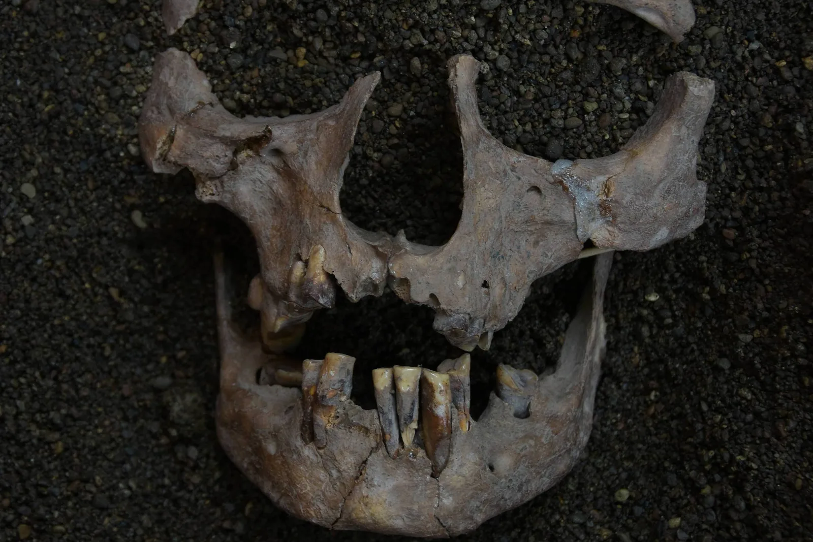 Dentes de caçadores-coletores revelam uso de noz-de-betel há 20 mil anos