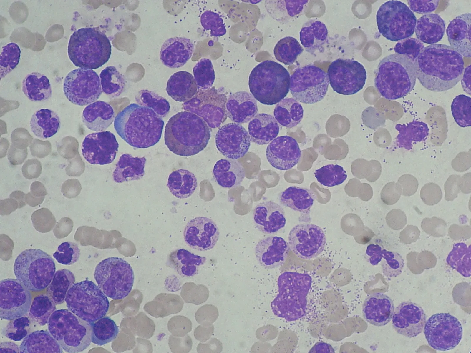 Combinação experimental força células de leucemia ao colapso energético